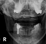 Dental implant crown