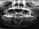 Permanent mandibular retainer