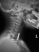Coin in throat