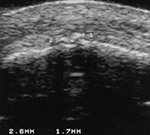 Knee calcifications on US