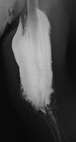 Contrast extravasation into the left arm