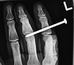Left index finger nail gun injury