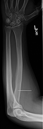 Sewing needle in forearm