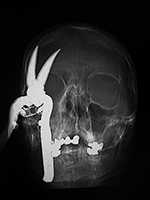 "Shear injury AP view"