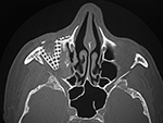 "Shear injury" CT image after orbital repair