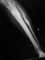 Antibiotic rod
