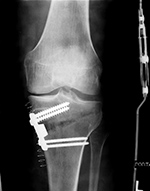 Short tibial osteotomy plate