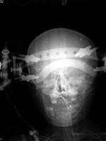Cranial tongs
