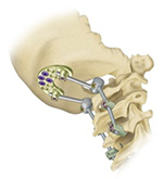 Den fracture fixation device for fusion occiput-C2