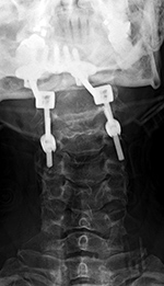Dens fracture fixation from occiput to C2