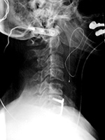 Esophageal temperature probe