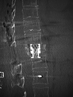 Expandable corpectomy cage CT image