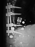 Expandable corpectomy device after device shift