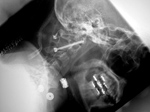 Odontoid fracture fixation