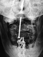 Odontoid screw AP view