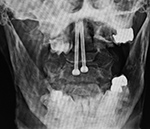 Odontoid screws