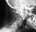 Odontoid screws
