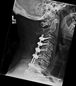 Posterior spinal fusion lateral view