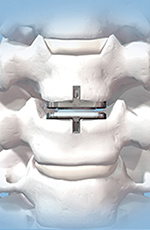 Pro Disc cervical disk