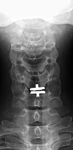 Prodisc-C cervical disk