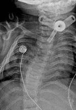 Tracheostomy tube AP view