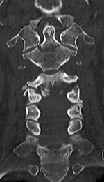 Type III dens fracture