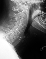 Vague nerve stimulator lateral view