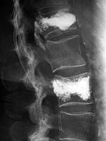 Vertebroplasty