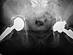 Right hip osteolysis and particle disease with displaced acetabular implant component