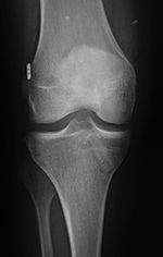 ACL repair