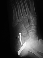 Calcaneal autogenous bone graft