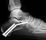 Calcaneal autogenous bone plug