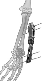 Stableloc external fixator
