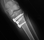 Hydroxyapetite bone wedge