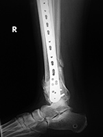 Right tibia LISS plate and bone substitute