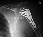 Left humerus periarticular locking plate