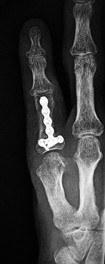 Little finger reconstruction plate