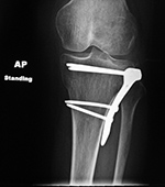 Tibia buttress plate