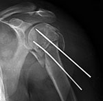 Steinman pins in shoulder