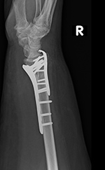 Ulnar hook locking plate