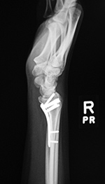 Volar distal radius locking plate
