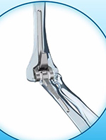 Total elbow prosthesis