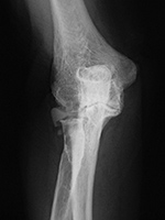 Radial head silicone prosthesis
