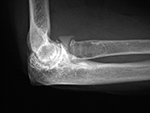 Radial head silicone replacement