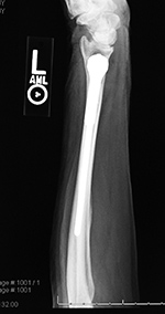 Left wrist DRUJ prosthesis
