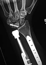 Left distal radioulnar joint hemiarthroplasty