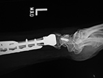 Left distal radioulnar hemiarthroplasty