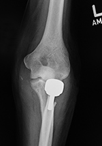 Left radial head prosthesis