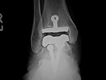 Total ankle arthroplasty