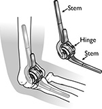 Semiconstrained elbow arthroplasty